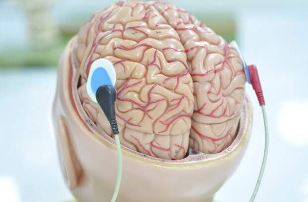 Стимуляция головного мозга электродами