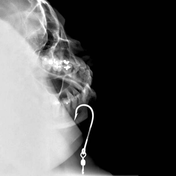 Крючок, зацепленный за губу крючки, предметы в прямой кишке, рентген