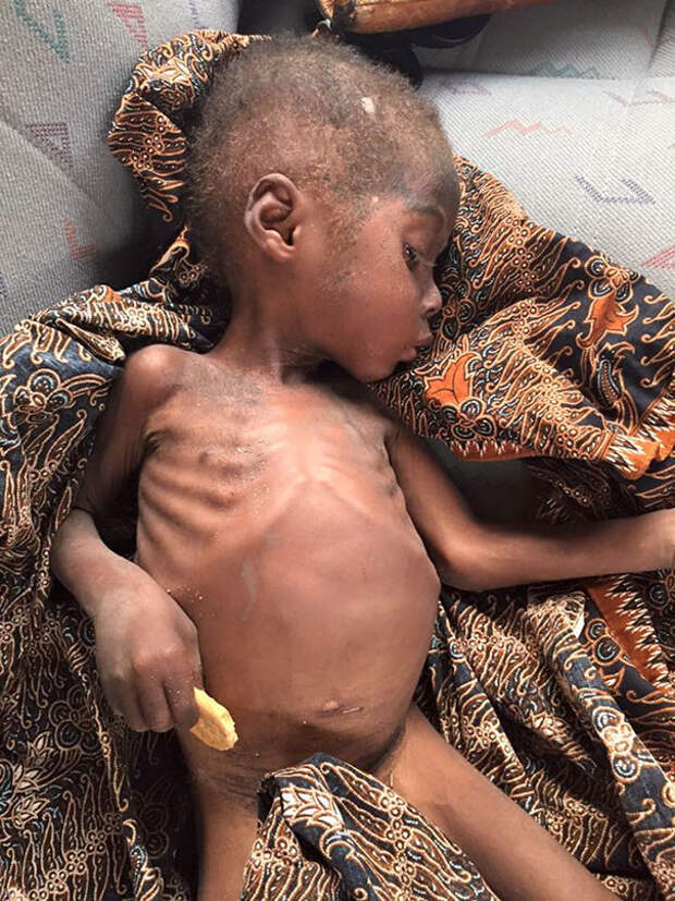 Организм ребенка был сильно ослаблен из-за истощения и глистов мальчик, нигерия, спасение