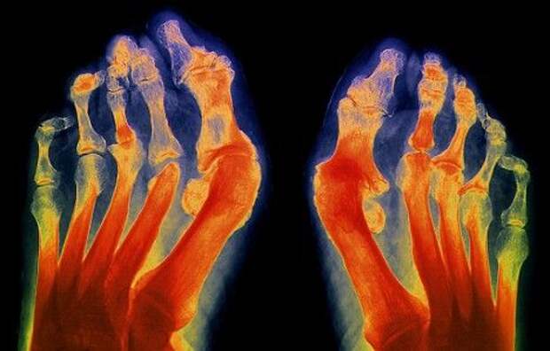 ревматоидный артрит пальцев ног