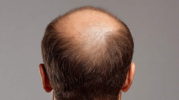 Приданое под угрозами: женщина подала в суд на мужа из-за лысины