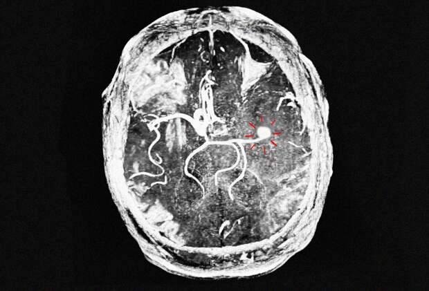 В Рязанской ОКБ спасли мужчину с нарушением мозгового кровообращения