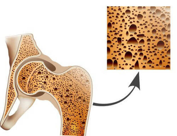 Разница между артрозом, артритом и остеопорозом
