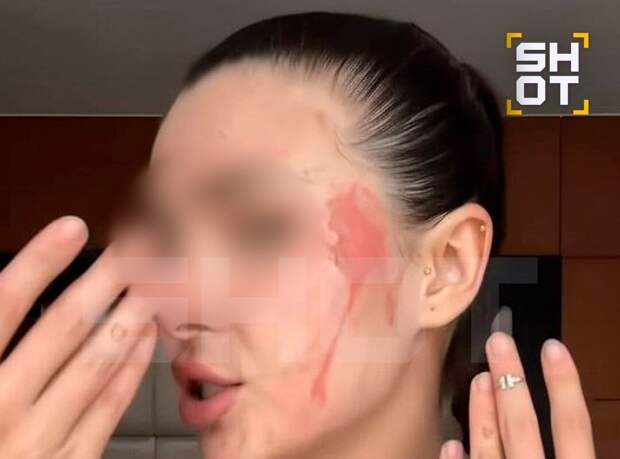 Россиянка получила ожоги лица и едва не ослепла из-за насекомого на Бали