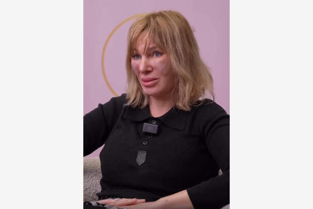 Пластический хирург показала изуродованную косметологом женщину и впечатлила россиян