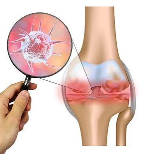 Реактивный артрит