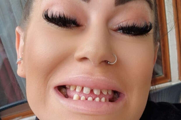 Британка лишилась $24 тысяч и работы после неудачного лечения зубов