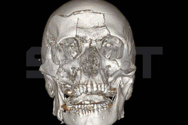 SHOT: в Подмосковье мужчина раскрошил себе лицо, упав со снегохода