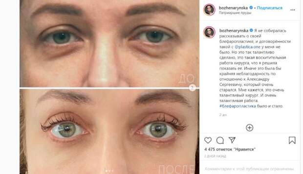 Рынска похвасталась результатами блефаропластики, которую успела сделать до карантина