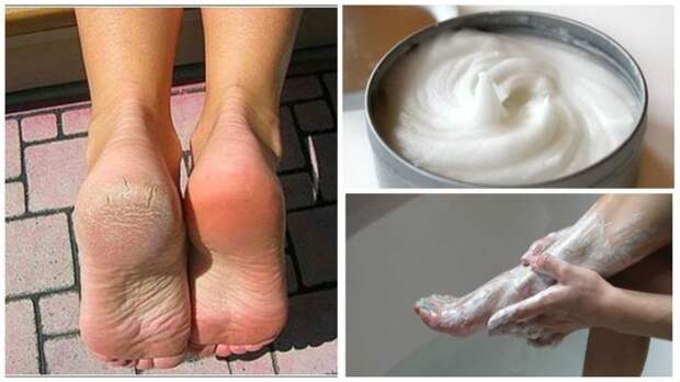 Elimina-los-hongos-y-los-callos-de-los-pies-con-este-increíble-remedio-casero-e1484982907289-2