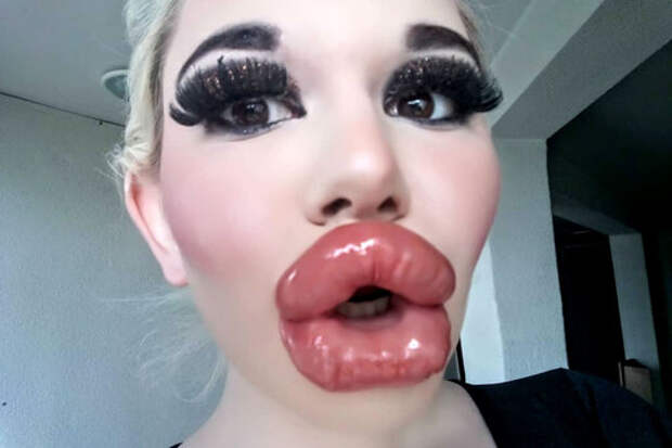 «Я люблю их, но мне больно есть»: девушка сделала себе самые большие губы в мире