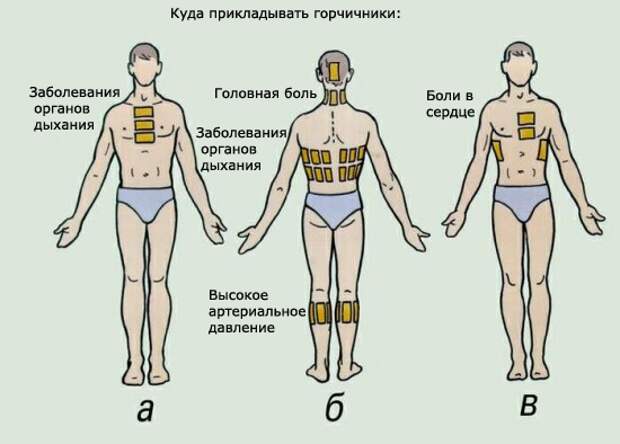 Как правильно ставить горчичники