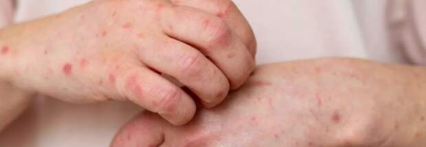 Жители Мангистау стали чаще болеть корью: большинство - непривитые