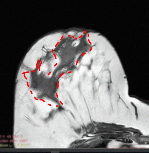 В Рязани вылечили сложнейшую патологию молочной железы