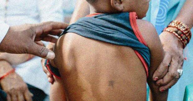 Чили первой в обеих Америках искоренила лепру — второе признание в мире