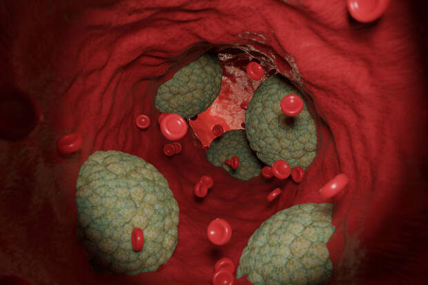 ESOC: накопление белков в сосудах мозга повышает риск деменции в четыре раза
