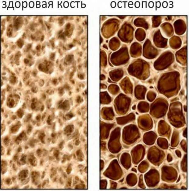 Почему наше тело становится хрупким