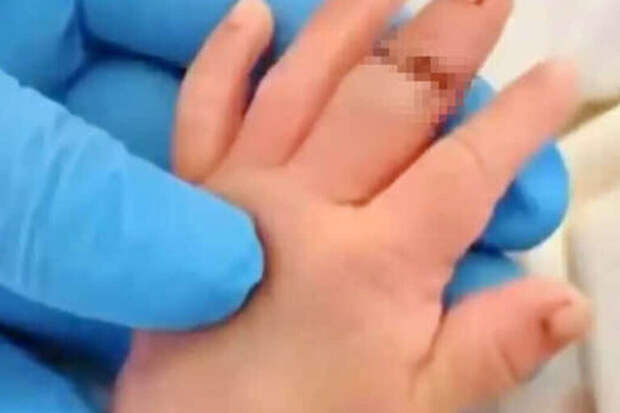 Акушерка случайно повредила палец новорожденному во время родов в Китае