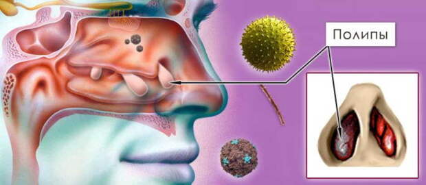 2 дня - и полипа в носу как не бывало!