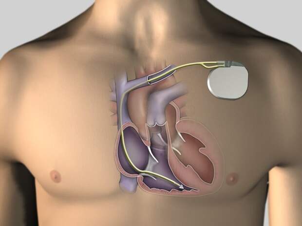 Ученые создали растворимый кардиостимулятор
