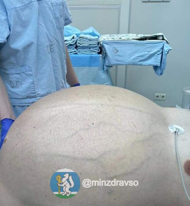 На Урале мужчине удалили гигантскую опухоль весом со взрослого человека