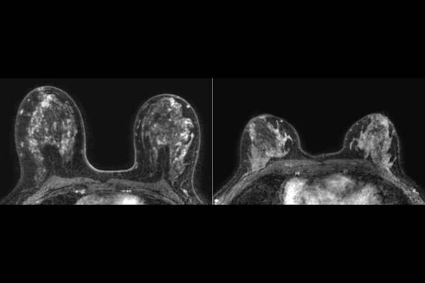 NatGen: рак молочной железы меняет свой метаболизм, чтобы выжить в мозге