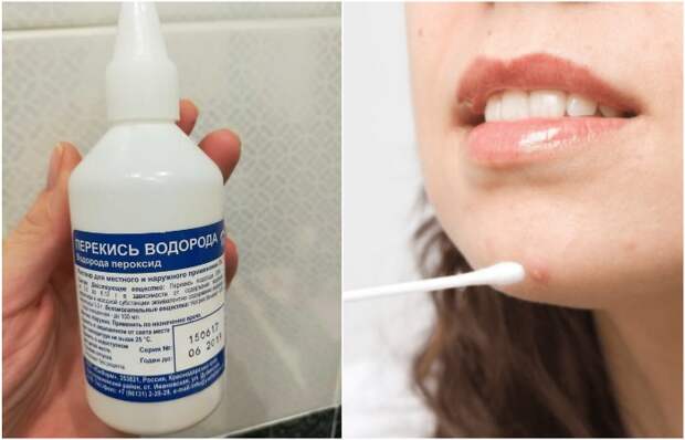 Смочите ватную палочку в перекиси водорода и прижгите прыщ Смочите ватную палочку в перекиси водорода и прижгите прыщ