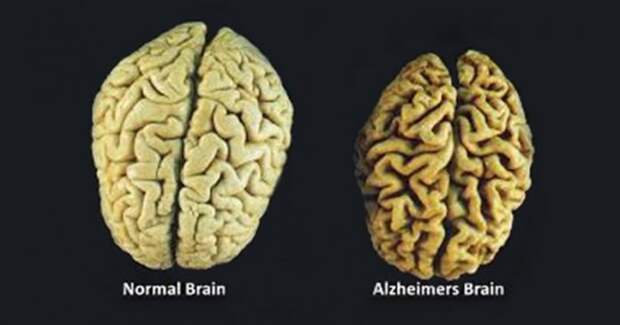 3-vitamins-prevent-brain-loss