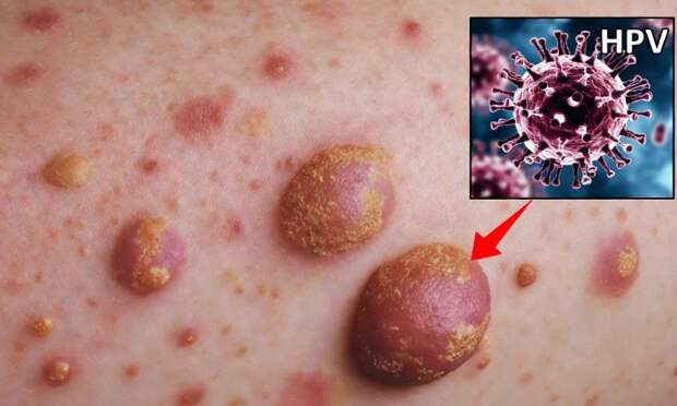 Онколог Мироненко предупредил, вирус папилломы и гепатита грозят онкологией