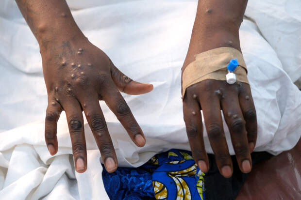 Оспа обезьян добралась до Подмосковья