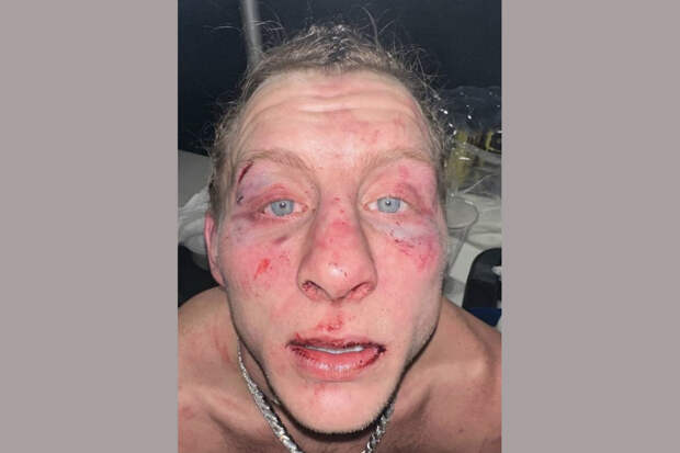 Появилось фото обезображенного лица Пимблетта после поединка с Гейджи