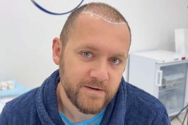 Звезда сериалов «Мажор» и «Бывшие» показал внешность после пересадки волос