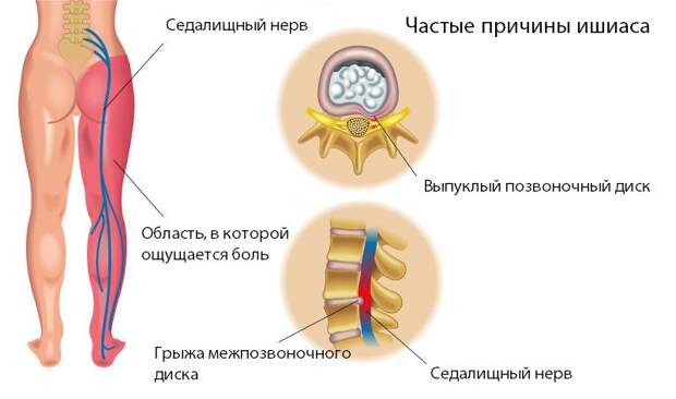 Что такое ишиас?