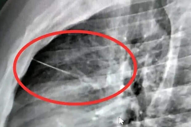 Врачи спасли 19-летнюю жительницу Подмосковья, которая проглотила швейную иглу