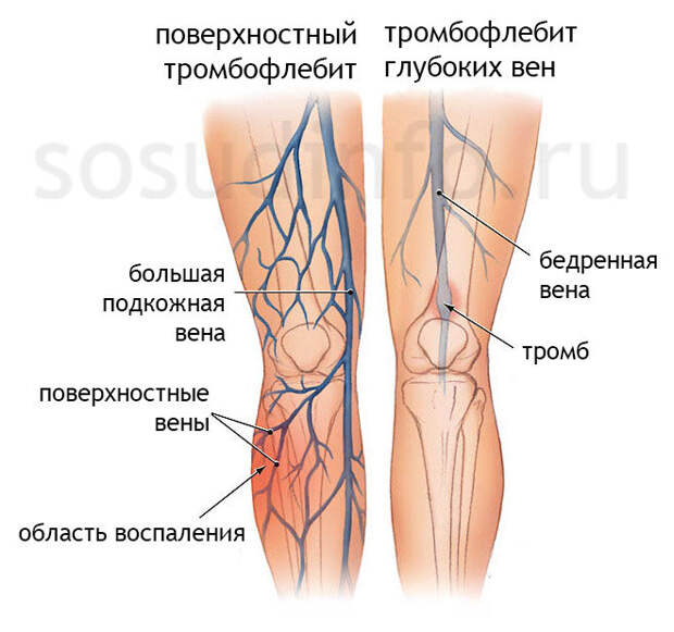 Первые симптомы тромба в ноге