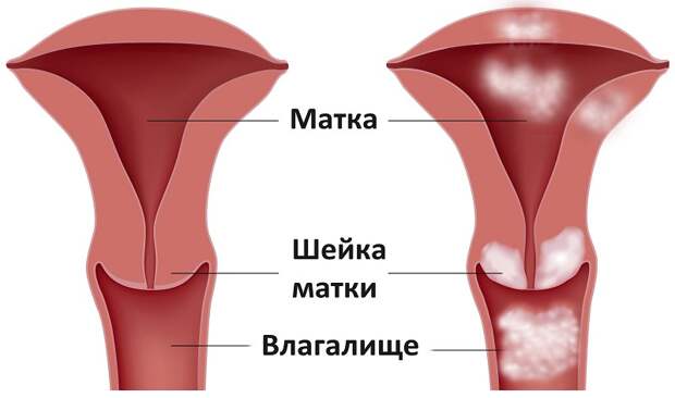 диагнозы в гинекологии