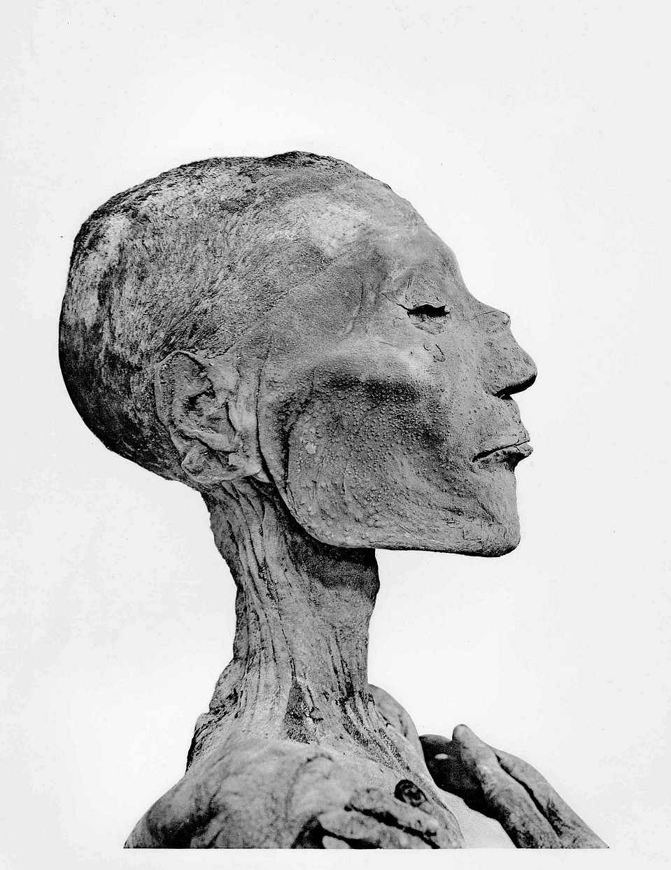 Пустулы на коже лица мумии Рамсеса V. Каир, Египетский музей. Фото: Catalogue General Antiquites Egyptiennes du Musee du Caire: The Royal Mummies. - Le Caire, 1912. 