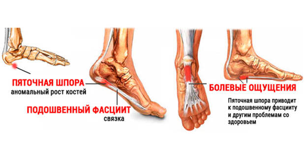 Узнайте как вылечить пяточною шпору — 8 народных рецептов