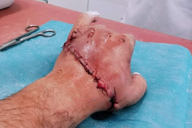 photo_2025-10-06_00-33-58 травматическая ампутация кисти