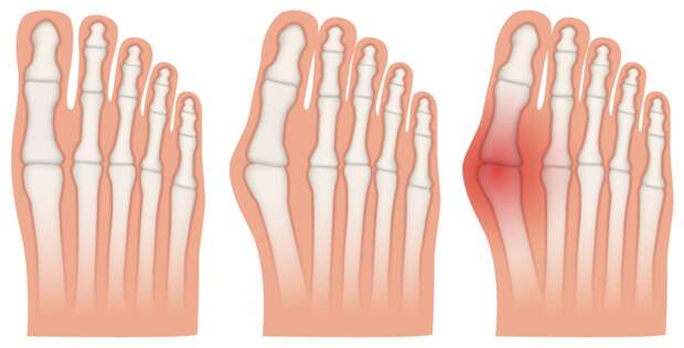 Косточка на большом пальце: в каких случаях операция нужна, а когда - нет