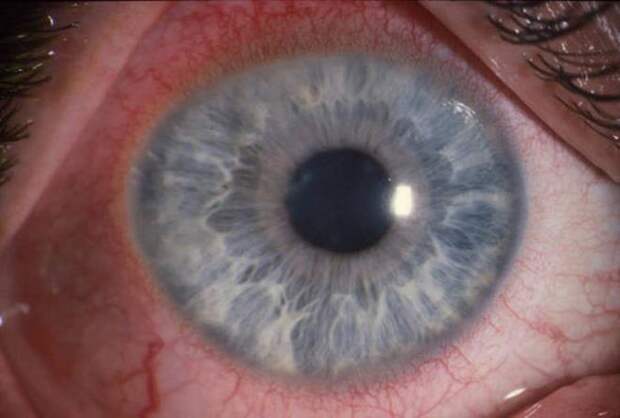 Красные глаза – причины и лечение у взрослого