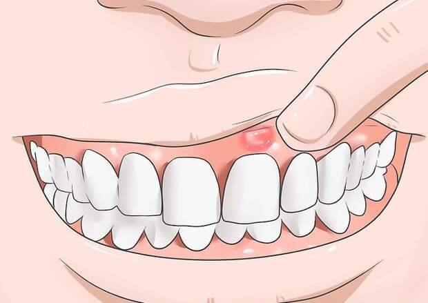 Эпулис на десне: причины появления и методы лечения