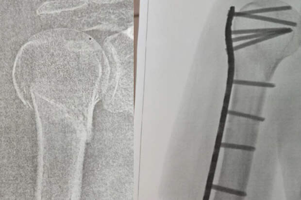 Жительница Новосибирска требует компенсацию с магазина за тяжелый перелом