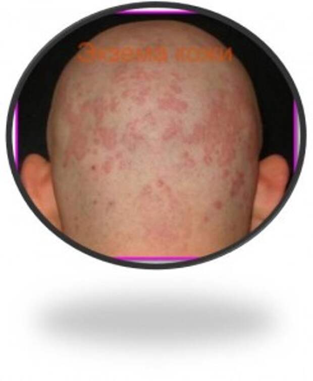 Средства от экземы