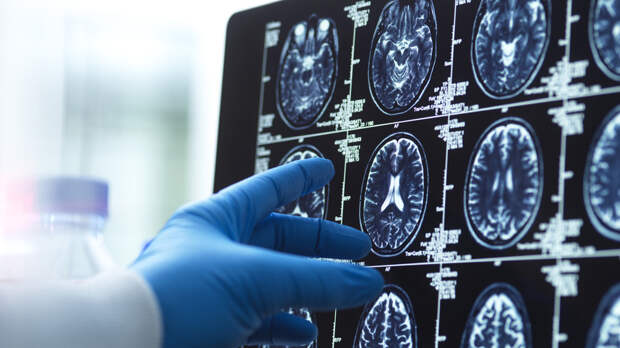 Врач Жарова рекомендовала контролировать давление для снижения риска деменции