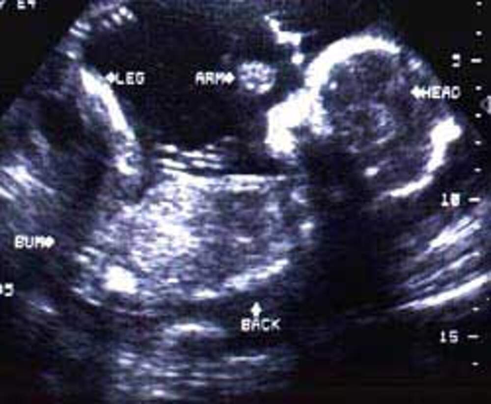 В 20 недель голова. УЗИ 20 недель беременности фото. Снимки УЗИ на 20 неделе беременности.