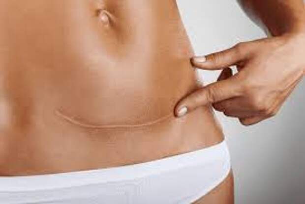 Ударно-волновая терапия (УВТ) как метод лечения рубцов