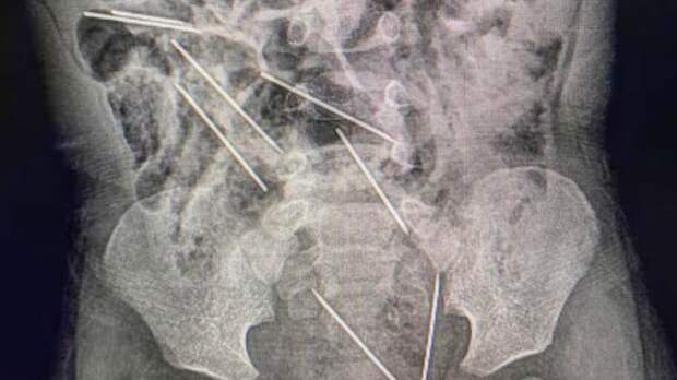 Перуанские врачи спасли ребенка, проглотившего восемь игл