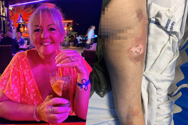 Daily Mail: британка осталась с ожогами из-за взорвавшегося вейпа