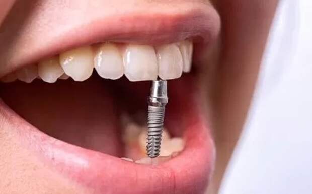Цены на имплантацию зубов